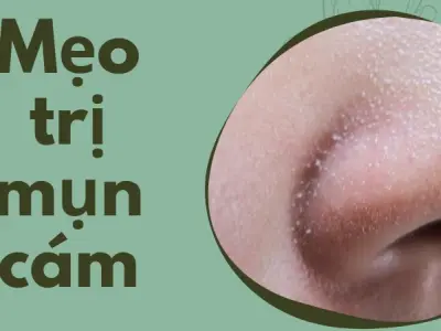 Mẹo trị mụn cám giúp da mịn màng chỉ sau 7 ngày áp dụng!